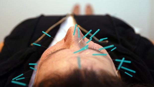 Una paciente sometiéndose a una terapia de acupuntura