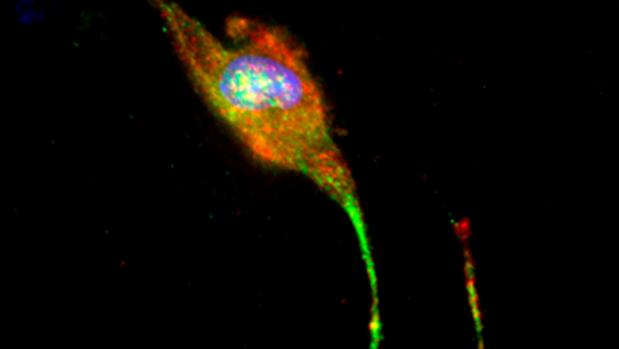 Neurona generada de células de la piel de paciente