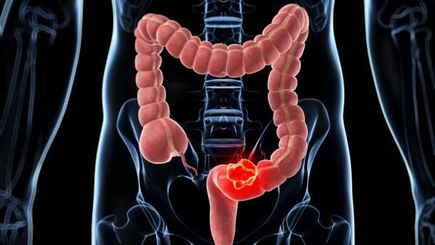 El cáncer de colon es el más frecuentemente diagnosticado en España