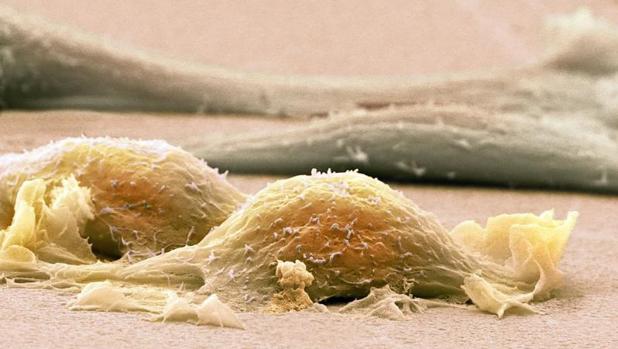 Una de las principales señales de alarma del sarcoma es la aparición de un bulto o dolor en las extremidades